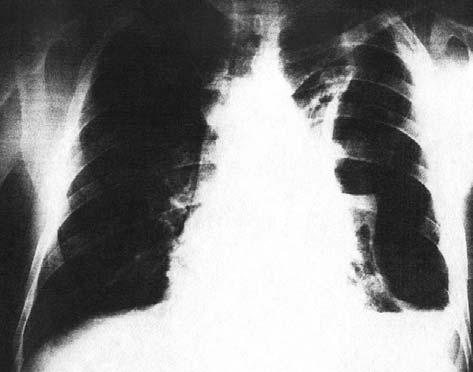 Компјутеризована томографија грудног коша (Слика 4): без инвазије у крвне судове ни у перикард. Лечење настављено плеурним пункцијама.