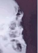 januar-mart/2013. Vol. 11 - Broj 1 Hipoplazija desnog frontalnog sinusa i sinusitis desnog maksilarnog sinusa. Frontalni rendgenogram paranazalnih šupljina.