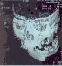 Desni profilni rendgenogram paranazalnih šupljina.