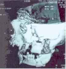 Ipsilateralni maskilarni sinus, etmoidni i sfenoidni sinusi urednog rendgenološke prezentacije. Fraktura desnog frontalnog sinusa. CT kranijuma.