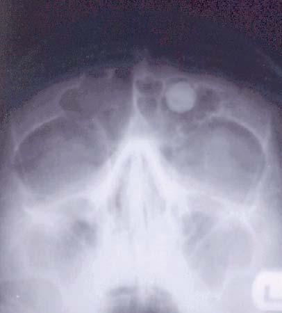 Fraktura mandibule udružena je sa frakturom i ispadanjem zuba na mestu preloma. Slika 8. Osteom levog frontalnog sinusa.