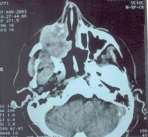 januar-mart/2013. Vol. 11 - Broj 1 Maligni tumor desnog maksilarnog sinusa.