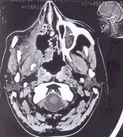 Slika 10 b Tumor mekog tkiva desne polovine lica. CT kranijuma.