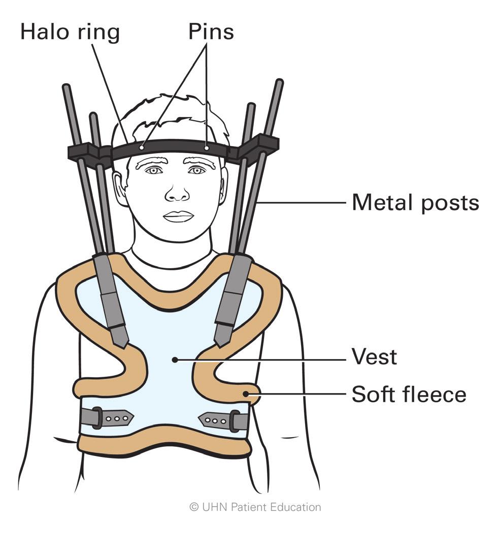 The halo vest weighs about 5 to 7 pounds (as much as a small bag of flour). It should fit snugly (you should be able to fit one hand between the vest and your abdomen or belly area).