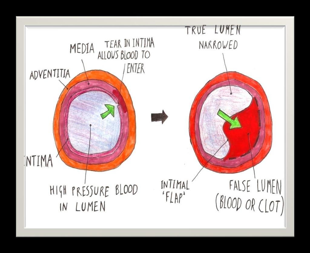 Etiologija degenerativna arterijska hipertenzija trudnoća konstitucija (skolioza) bolesti vezivnog