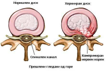 Слика 1 Заболени пршлени; Picture 1 Diseased vertebrae; На слика 1 е покажан заболен пршлен од дискус хернија и можеме да забележиме дека во првиот дел на сликата се работи за нормален пршлен, во