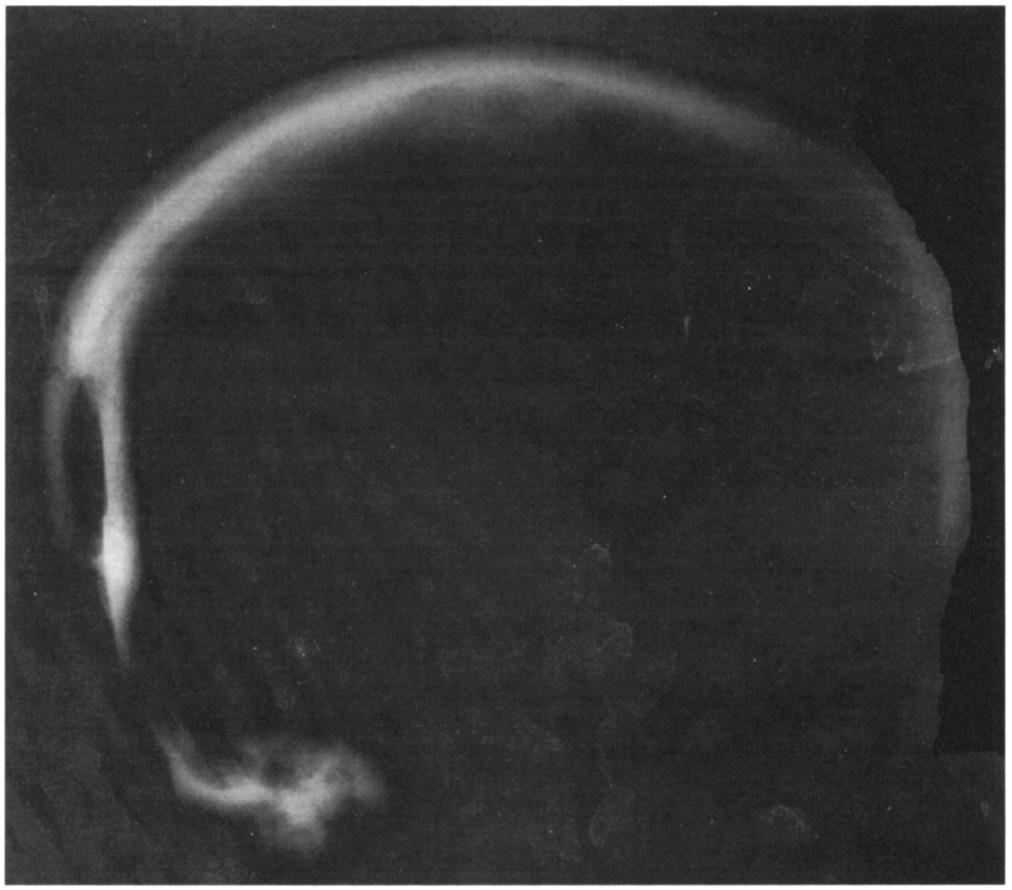 EXCAVATIONS IN THE HAGIOS CHARALAMBOS CAVE 589 Figure 34. Skull AX 14/18. Radiograph showing inward displacement of bone. Figure 35. Skull 1012. Multiple head traumas.