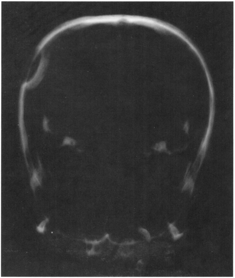 EXCAVATIONS IN THE HAGIOS C H A RAL AM B O S CAVE 591 Figure 39. Skull 1012. Radiograph showing inward displacement of bone. The third trephination patient was a male (no.