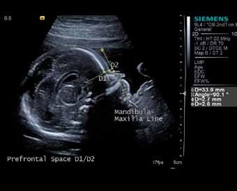 Medicina Prefrontalni prostor kot kromosomski označevalec za Downov sindrom v drugem trimesečju nosečnosti. Avtorica slike: Darija Strah in blago izraženi mozaiki?