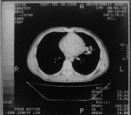 Kompjuterizovana tomografija grudnog koša Slika 4. Kontrolni radiogram grudnog koša nakon dvomesečne terapije Slika 5.
