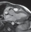 Short-axis view istovremeno prikazuje oba ventrikula okomito na septum,