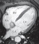 Slika 6 a,b,c,d Dodatni presjeci Od dodatnih presjeka svakako treba spomenuti presjeke kojima prikazujemo srčane valvule, presjeke za prikaz desnog atrija i ventrikula (2-chamber view (RV), vertical