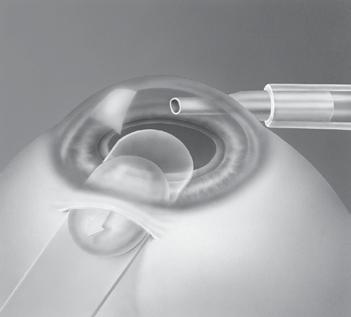 Glides IOL Glide [Hessburg] 0.6 mm thick. Phaco glide portion is designed to protect the iris from prolapse or trauma during phacoemulsification and acts as a guide for insertion of instruments.