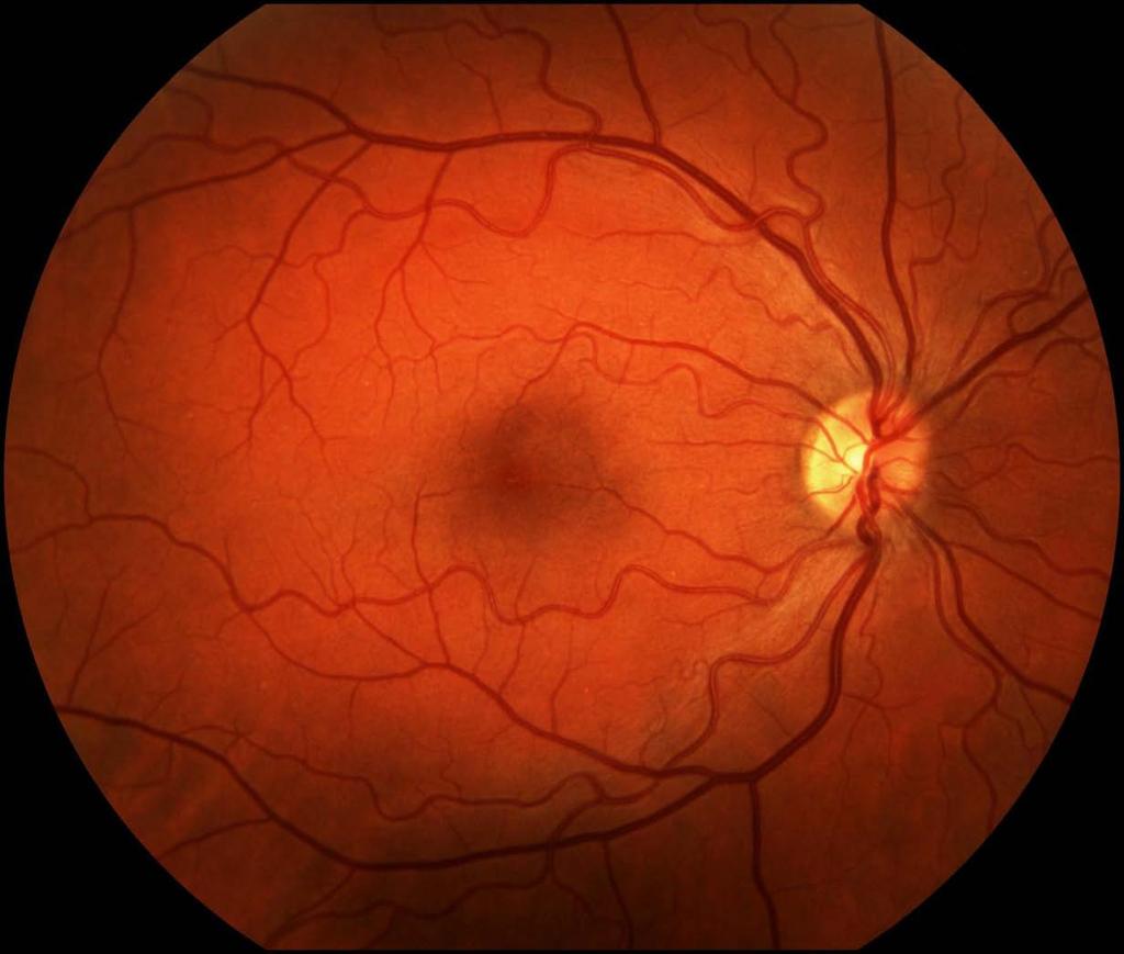 Mrežnjača Kao što smo videli u delu o anatomiji oka, optički deo mrežnjače je jedini deo oka osetljiv na svetlost.