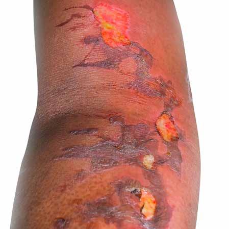 burn care WELCOME Covering all your Wound Care needs DeRoyal's Burn Treatment line offers you the largest selection of standard burn dressings available on the market.