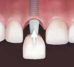 ДА ЗА ДЕНТАЛНИ ИМПЛАНТИ енталните импланти во последните 25 години доживеаја голем напредок како во однос на формата така и на квалитетот претставувајќи совршена алатка за замена на природните заби.
