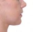 дерматолозите при појава на бенигни и малигни тумори на кожата на лицето и вратот.