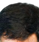ВЛАКНО ПО ВЛАКНО ПРИРОДЕН ИЗГЛЕД Оваа метода има многу предности и е многу популарна бидејќи косата трансплантирана на ќелавите делови ја има истата боја и природен изглед како и останатата.