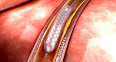 каротидните артерии (многу често паралелно егзистираат), а со цел градење соодветна стратегија за третман y функционални тестови коронарен стрес-тест, стрес-ехокардиографија или миокардна и