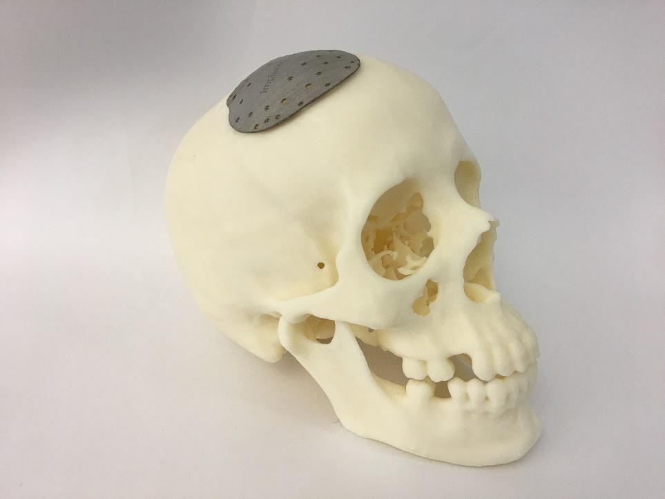 fabrication of cranial implants