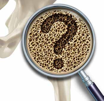 TEMA MESECA IMEJTE RADI SVOJE KOSTI MISLITE NA PRIHODNOST! OSTEOPOROZA LAHKO PRIZADENE TUDI MOŠKE Osteoporoza je bolezen, ki prizadene številne po vsem svetu.