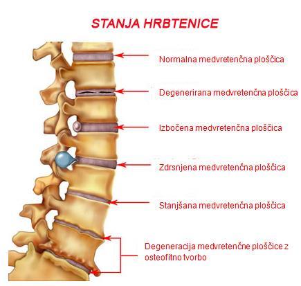 Slika 7 Stanja hrbtenice (Stanja hrbtenice, ki povzročajo bolečine v vratu in križu, 2015 ) Na sliki 12 so nekatera stanja hrbtenice, ki prepeljejo do bolečine v hrbtenici. 1.4 VPLIVI VAJ ZA RAZBREMENITEV HRBTENICE Če se pojavi enostavna bolečina, se odsvetuje ležanje.
