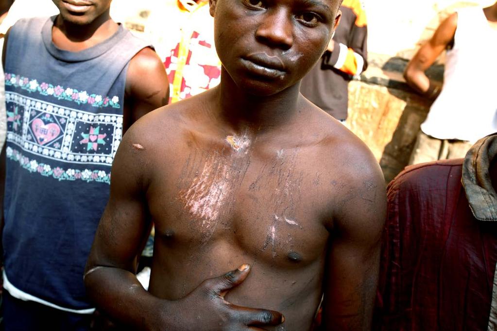 A boy in the Bukavu prison bears signs of burns he was inflicted with for an