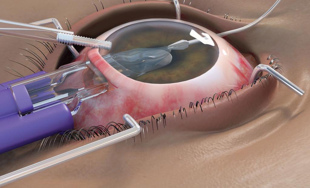11823 EndoGlide - Ultrathin Glide Introducer Design Features Oval diameter designed to fit through a 4.5mm scleral or 4.