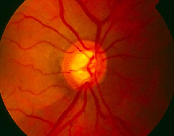 Глаукомын үнэлгээний хяналтын хуудас (үргэлжлэл) Харааны мэдрэл Харааны мэдрэлийг үнэлж глаукомын өвөрмөц өөрчлөлтүүдийг илрүүлнэ.