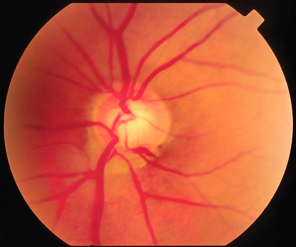 Харааны мэдрэлийн эрт үеийн гэмтэлд харааны мэдрэлийн хөхлөгийн (ХМХ) хонхойлт 0.