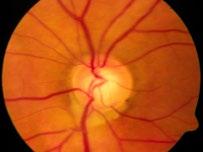 Нээлттэй өнцөгт глаукомын үргэлжлүүлэн хийх эмчилгээ Глаукомын дараагийн шатны менежмент нь эмчилгээний үр дүн, өвчний даамжрал, тогтворжилтыг үнэлэхээс хамаарна.