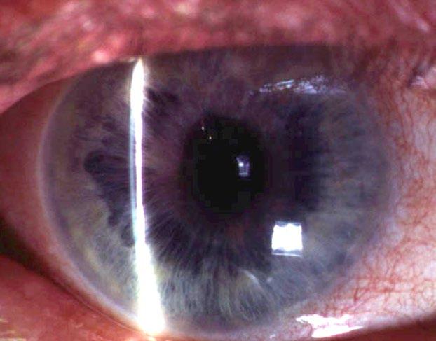 Хаалттай өнцөгт глаукомыг оношлосон бол хараа алдалтаас сэргийлэхийн тулд өвчтөнд уг өвчний явц, шаардлагатай эмчилгээний тухай дэлгэрэнгүй мэдээлэл өгөх хэрэгтэй.