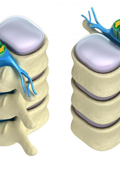 Whiplash Spine deformity Spinal cord injury