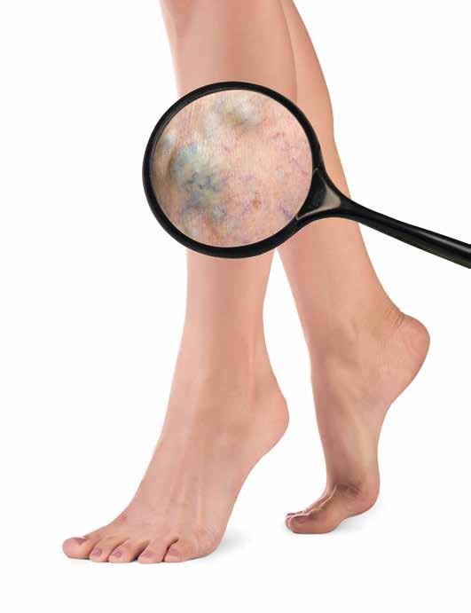 Jeste li u riziku od pojave proširenih vena na nogama?