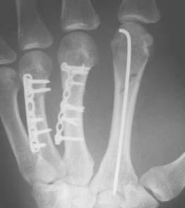 Zlomi nastanejo kot posledica padca na roko, udarca s predmetom ali udarca s pestjo ob trd predmet. Glavni znaki so oteklina na hrbtišču roke, bolečina na pritisk in lahko prikrajšava prsta.