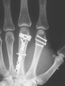 Najpogostejši zaplet takih zlomov je rotacijska deformacija z zmanjšano gibljivostjo prsta in prekrivanjem s sosednjim prstom.