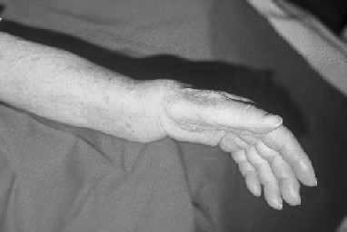 Anamneza padca, pri katerem se je poškodovani lovil na roko, zlasti padec z višine ali ob športni aktivnosti, padec vznak, pri starejših pa že nedolžen padec v isti ravnini, mora zdravniku vzbuditi