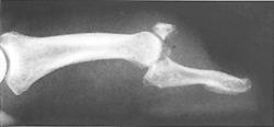 Kovač M, Pšenica J. Zapleti poškodb kosti in sklepov v predelu roke Slika 2. Redka indikacija za operativno zdravljenje.
