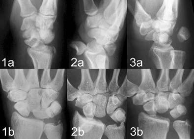 Kovač M, Pšenica J. Zapleti poškodb kosti in sklepov v predelu roke Slika 8. Različne oblike perilunarnih luksacij.