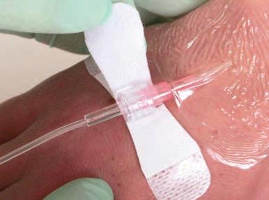 Extension Sets Some of the most common complications of IV starts, including phlebitis and site infection, can arise from over-manipulation of the catheter hub.