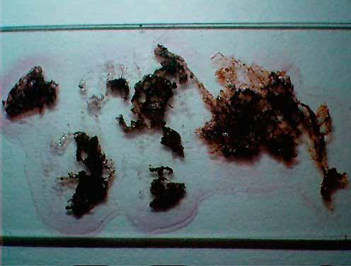 Morgellonova bolezen test z rdečim vinom Alojz Ihan Napad nano tehnologije na človeško telo Morgellonova bolezen je bolezen, povezana s kemičnim pršenjem neba (chemtrails).