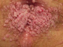 b) Analne displazije in analni ploščatocelični karcinom Pomemben zdravstveni problem za moške, ki imajo receptivne analne spolne odnose, predstavlja naraščanje incidence analnih displazij in