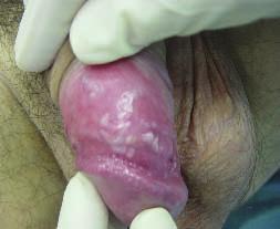 43 AKTUALNO da mu razložim možne vzroke, vključno s prenosom HSV z ustnic na zadnjik. Ko ugotovim spolno prenosljivo okužbo, npr.