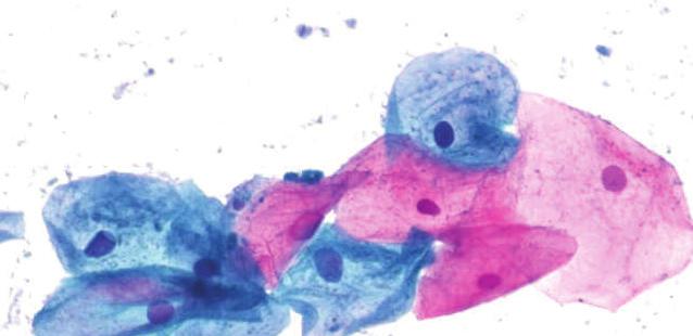 Cytology Reagents for brilliant and highly reproducible sensitive results To stain gynecological and clinical specimens, use standard Papanicolaou sample staining with hematoxylin Gill s solution.