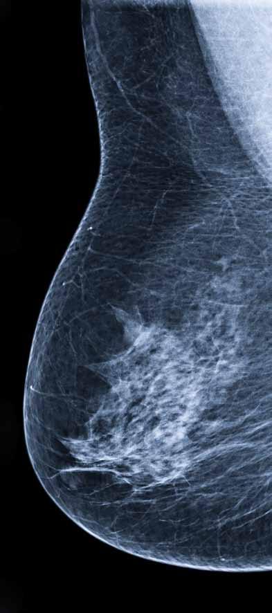 10 Ionizirajoče sevanje: Zvišuje ogroženost. Ogroženost pa je odvisna od doze. Doza pri sodobnih mamografijah je nizka in koristi mamografije odtehtajo posledice sevanja.