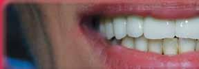 Čarovnija zobnih vsadkov Že način in tempo življenja nam diktirata, da je treba na nek način nadomestiti