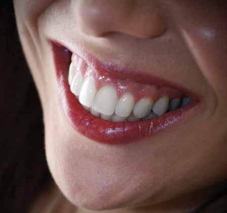 28 zobozdravstvo IJanez Šekoranja, dr. dent. med foto: istockphoto Krvava dlesen Vam kdaj zakrvavi dlesen?