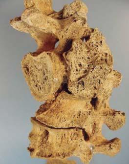 Similarly, the upper dorsal vertebrae exhibit cavities as a consequence of generalized osteolysis.