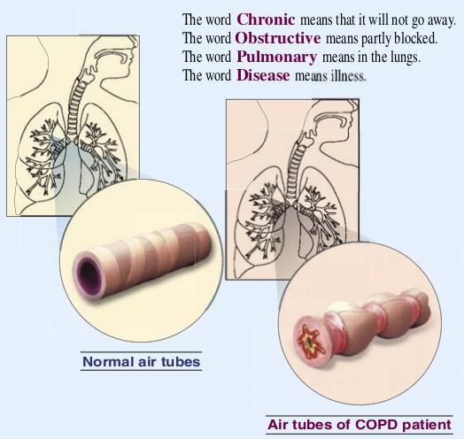 Published on: 8 Feb 2014 COPD What Exactly Does Copd Mean? COPD is the short form for Chronic Obstructive Pulmonary Disease.