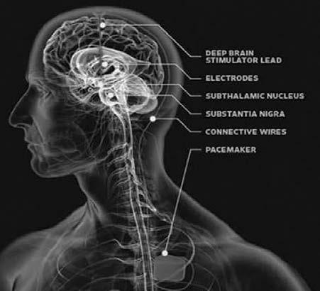 Primjena terapije duboke mozgovne stimulacije pomaže oboljelima od Parkinsonove bolesti, distonije, tortikolise i esencijalnog tremora ali i osobama koje se nalaze u vegetativnom stanju. Doc.